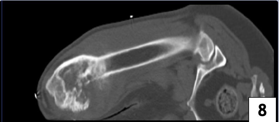 Apendiküler Osteosarkom Teşhisli Bir Köpekte Stereotaktik – görsel 5