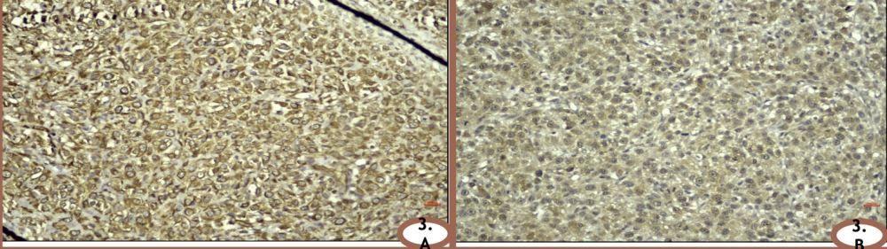 Figür 3. Nazal lenfomanın immünohistokimyası. 200X Bar= 20 µm (A). Vimentinin güçlü ve yaygın ifadesi. (B)…