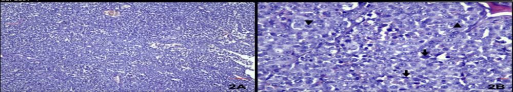 Figür 2 H&E. A. İnce fibröz stroma ile ayrılmış tümör dokusu. 100X, Bar=100µm B. Belirgin hücre sınırları olmayan (ok başı)…