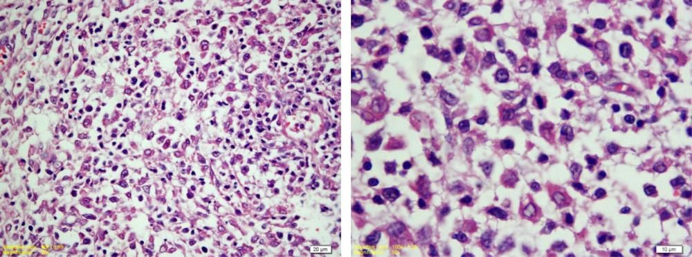 Resim 6 ve 7 : Submandibular kitle, atipik histiyositik hücreler ve lenfositler (H&E, Bar 20 μm ve Bar 10) μm)