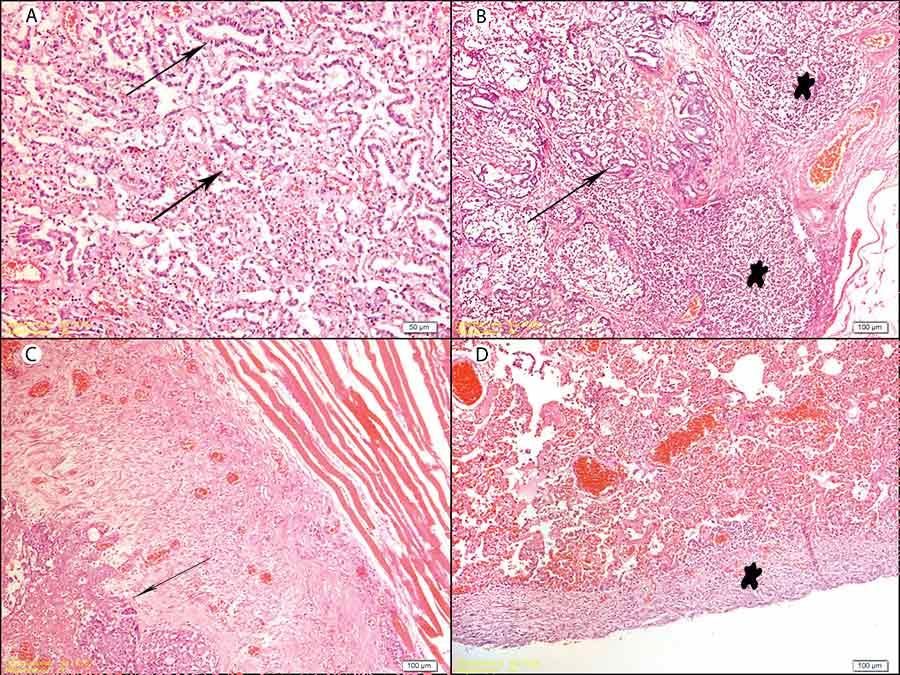 Resim 4. A. Akciğer, alveoller bölgelerde yaygın durumda tubul formları oluşturmuş metastazik karsinom alanları (ok). B. Mediastinal lenf nodu…